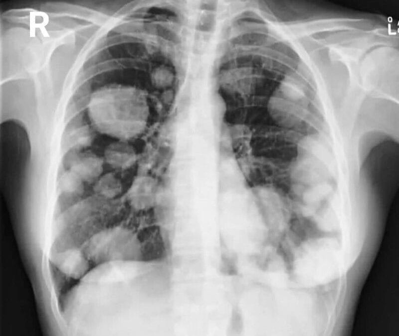 VAPEAR, UN RIESGO BANALIZADO